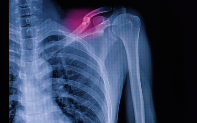 Projeto inovador melhora eficiência e conforto no tratamento de fraturas ósseas