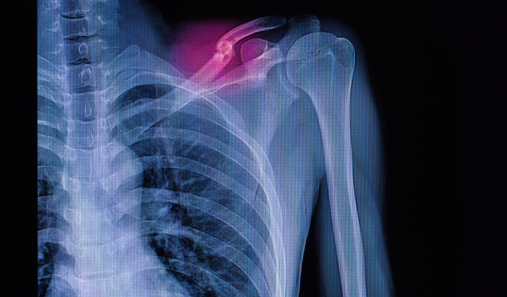 Projeto inovador melhora eficiência e conforto no tratamento de fraturas ósseas